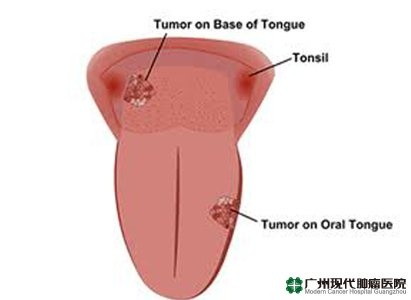 سرطان اللسان,طريقة العلاج لسرطان اللسان