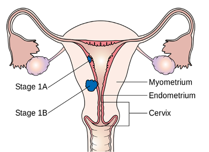  Endometrial Cancer Symptoms 