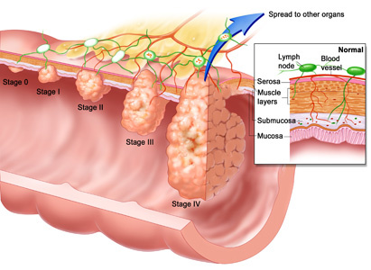 Anal Cancer Symptoms