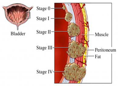 Bladder Cancer Treatment, Bladder Cancer