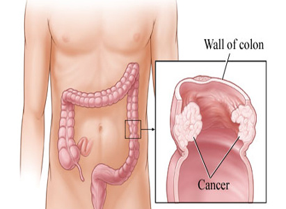 Colorectal Cancer Diagnosis