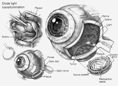 Eye Cancer Treatment,Eye Cancer