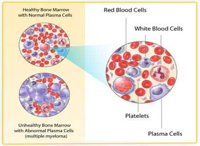 Multiple Myeloma Diagnosis