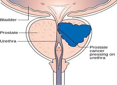  Prostate cancer, prostate cancer treatment