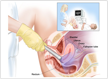 ovarian cancer, ovarian cancer diagnosis