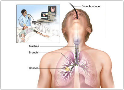 Diagnosis of lung cancer,lung cancer diagnosis,Modern Cancer Hospital Guangzhou