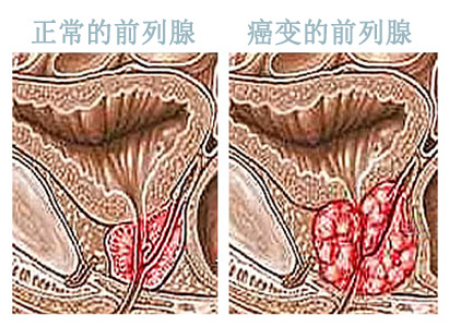 前列腺癌,前列腺癌症状