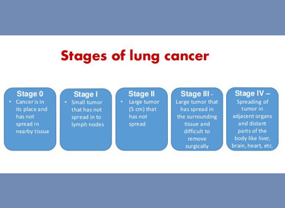 Understanding the stages of lung cancer and choose a suitable treatment plan for lung cancer at stage 1,2,3,4.