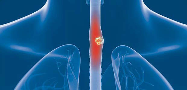 Esophageal cancer,Types of Esophageal Cancer,Staging of Esophageal Cancer, esophageal cancer treatment, minimally invasive therapy, St. Stamford Modern cancer Hospital Guangzhou 