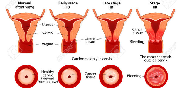 cancer,vaginal cancer, vaginal cancer symptoms, vaginal cancer diagnosis, vaginal cancer treatment