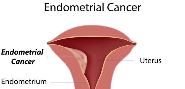 Endometrial Cancer, endometrial cancer symptoms, endometrial cancer diagnosis, endometrial cancer treatment
