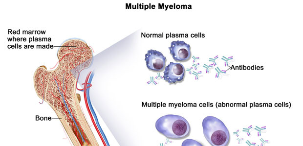 Multiple Myeloma,Multiple Myeloma symptoms, Multiple Myeloma diagnosis, Multiple Myeloma treatment