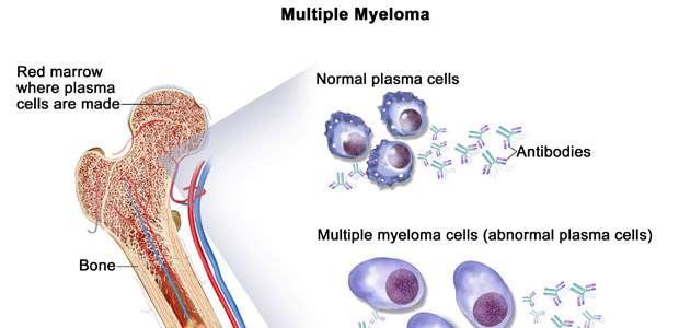 Multiple myeloma