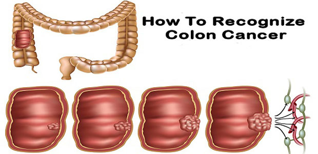 Colon cancer,Symptoms of colon cancer, causes of colon cancer, colon cancer treatment