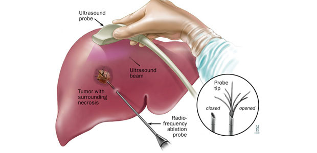 radiofrequency ablation, cancer treatment, cancer