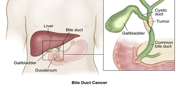Bile Duct Cancer,Types of bile duct cancers， bile duct cancer symptoms, bile duct cancer diagnosis, bile duct cancer treatment