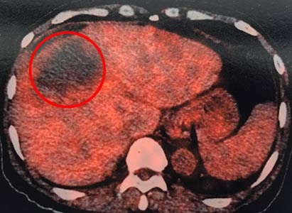 kanker hati, cholangiocarcinoma intrahepatik, St. Stamford Modern Cancer Hospital Guangzhou, Pengobatan Minimal Invasif, Pengobatan Kanker Hati, Intervensi, Cryosurgery, Microwace Ablation (MWA)