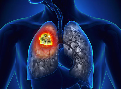 Stages of lung cancer