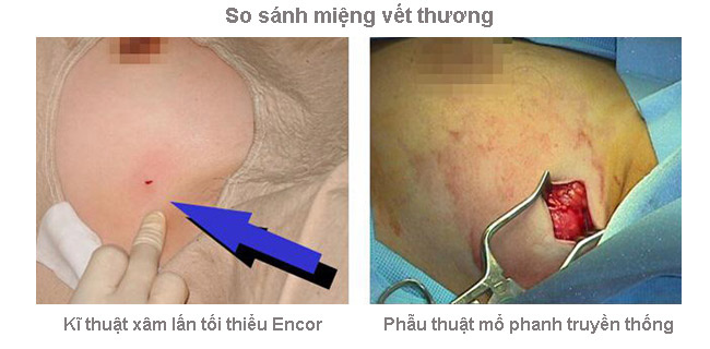 Ung thư vú, điều trị xâm lấn tối thiểu, Bệnh viện Ung thư St. Stamford Quảng Châu, kĩ thuật dao xoay hút chân không tuyến vú Encor Ung thư vú, điều trị xâm lấn tối thiểu, Bệnh viện Ung thư St. Stamford Quảng Châu, kĩ thuật dao xoay hút chân không tuyến vú Encor