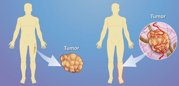 Soft tissue tumors,Soft Tissue Cancer Diagnosis