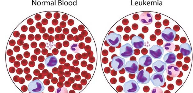 leukemia,Chronic myelogenous leukemia,Treatment for Acute Myeloid Leukemia