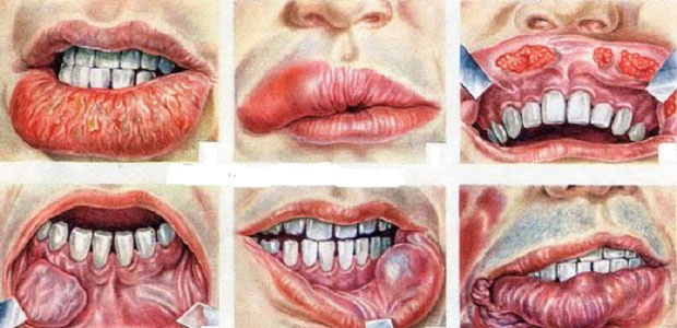 Oral Cancer,Symptoms of Oral Cancer,oral cancer diagnose