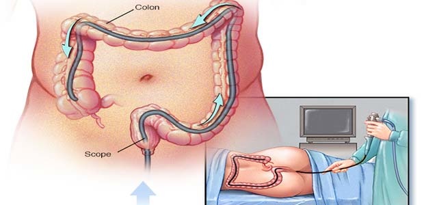 Colon cancer, diagnosis of colon cancer