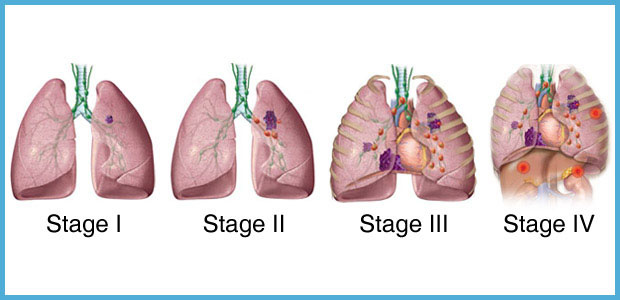 Lung cancer, lung cancer stages, St. Stamford Modern Cancer Hospital Guangzhou