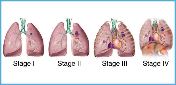 lung-cancer-staging-modern-cancer-hospital-guangzhou-china