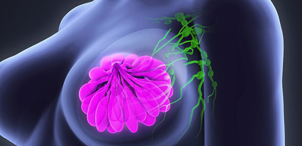 Breast Cancer, Breast Cancer case report, St. Stamford Modern Cancer Hospital Guangzhou