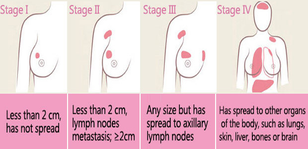 Breast Cancer, Breast Cancer stages, St. Stamford Modern Cancer Hospital Guangzhou