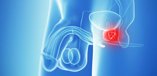 Prostate cancer, prostate cancer pathology report, St. Stamford Modern Cancer Hospital Guangzhou