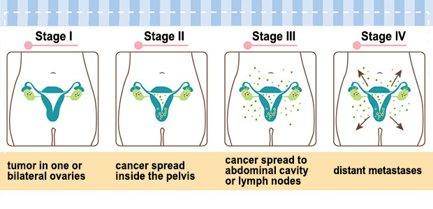 Ovarian cancer, ovarian cancer stages, St. Stamford Modern Cancer Hospital Guangzhou