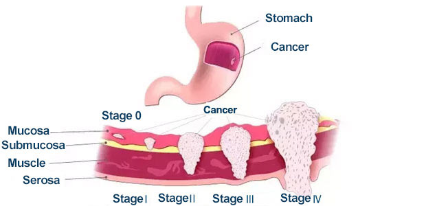 Stomach Cancer, Stomach Cancer stages, St. Stamford Modern Cancer Hospital Guangzhou