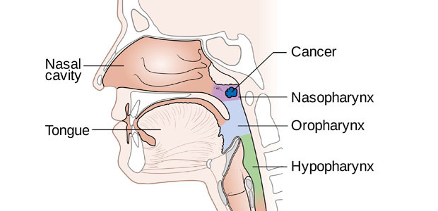 Nasopharyngeal cancer