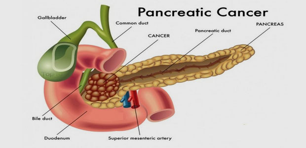 Pancreatic cancer, pancreatic cancer pathology report, St. Stamford Modern Cancer Hospital Guangzhou