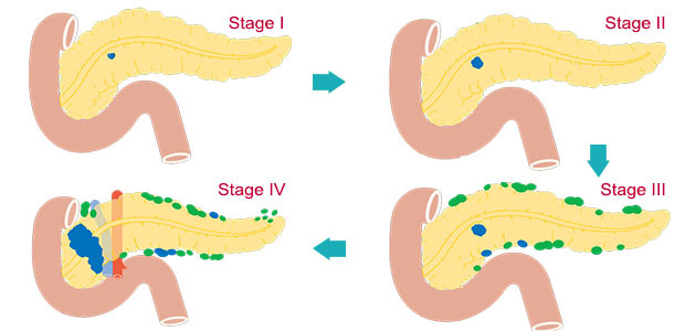 stage 1 pancreatic cancer