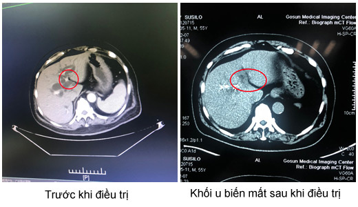 ung thư túi mật, điều trị phẫu thuật, Bệnh viện Ung thư St.Stamford, điều trị can thiệp, điều trị cấy hạt phóng xạ iodine 125, điều trị miễn dịch sinh học ung thư túi mật, điều trị phẫu thuật, Bệnh viện Ung thư St.Stamford, điều trị can thiệp, điều trị cấy hạt phóng xạ iodine 125, điều trị miễn dịch sinh học