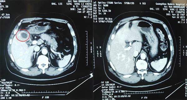 Kanker kandung empedu stadium IV jenis adenokarsinoma berdiferensiasi tinggi, kanker, metode pengobatan kanker, minimal invasif, intervensi, cryosurgery, St. Stamford Modern Cancer Hospital Guangzhou
