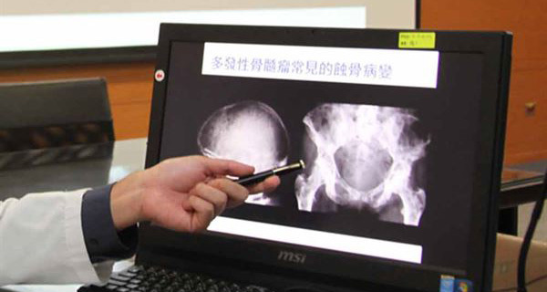  Multiple myeloma, diagnosa, St. Stamford Modern Cancer Hospital Guangzhou