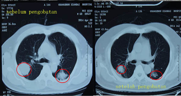 Kanker paru-paru kiri, Pengobatan Kanker, Modern Cancer Hospital Guangzhou, Intervensi, Cryosurgery, Penanaman Biji Partikel Yodium