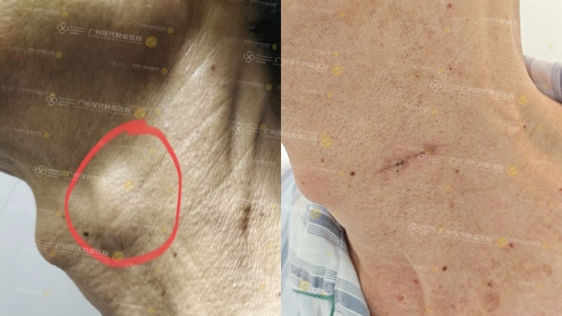 1-083040343.jpg 颈部淋巴结对比.jpg