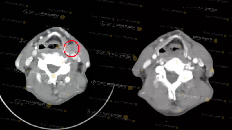 1-083143287.png 5、颈部:4月29日VS8月1日.png