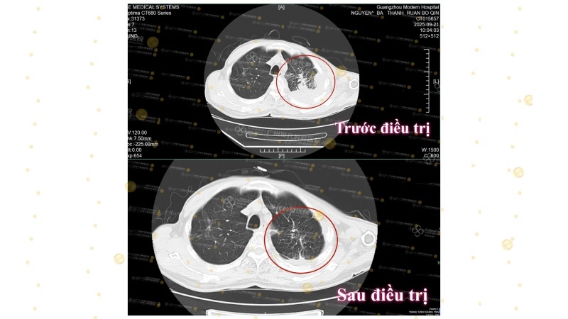 1-094529704.jpg 阮伯清CT对比图_副本.jpg