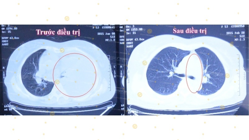 1-094654785.jpg 严氏秋CT前后对比图_副本.jpg