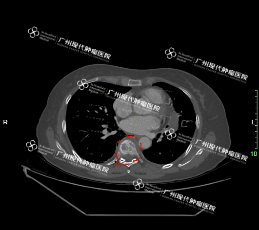 骨水泥治疗前2.png