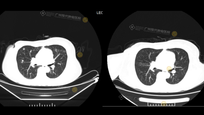 Leonisa治疗前后CT图.png