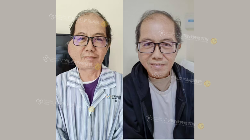 治疗前vs一个疗程后.png