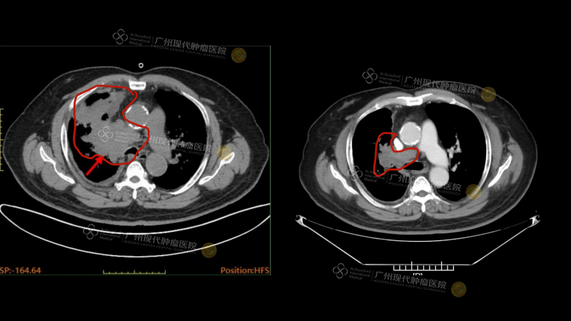 1-073740168.png 5 CT对比.png