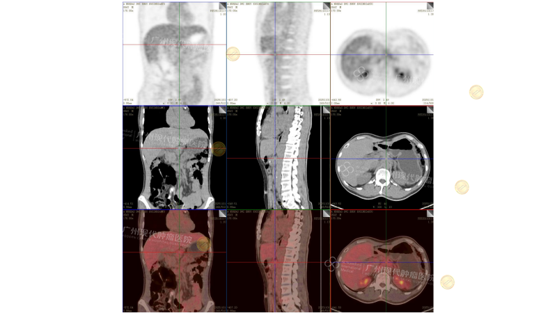 1-034319378.png 【治疗前】恩迪PET-CT 检查报告_02_副本.png